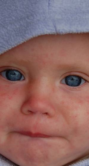 epidemia odry